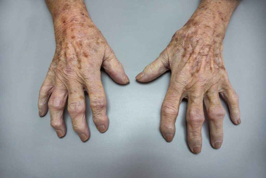 Osteoartritis. Qué es y otras preguntas osteoartritis qué es